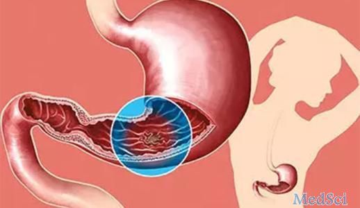 Gastrointestinal Endoscopy： 回肠切除术后孤立性吻合口溃疡克罗恩病患者出现轻度回肠复发的风险因素分析