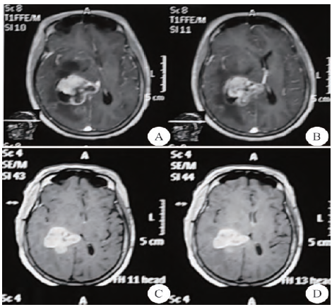 脑室外引流术联合分次立体定向放射外科治疗巨大脑转移瘤