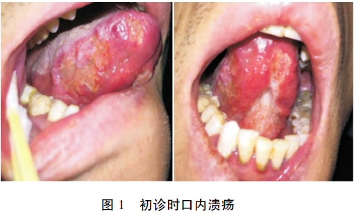 舌部溃疡伴疼痛不适，是何原因？
