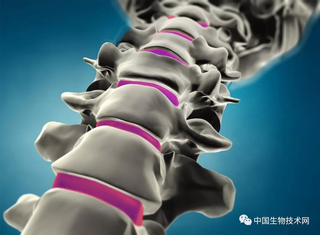 病例分析：脊柱痛风石压迫脊髓
