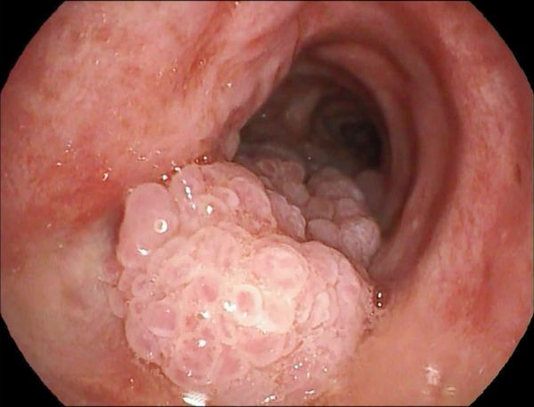 食管乳头状瘤白色图片