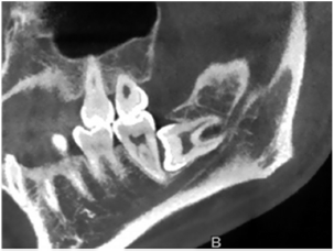 双种植钉牵引拔除高危下颌水平阻生智牙8例报道