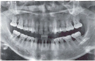 妊娠期多发性牙龈瘤1例