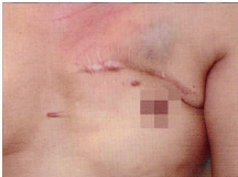 Gardner综合征合并慢性颌骨骨髓炎1例
