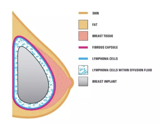 BMJ：隆胸需谨慎！乳房植入物被证实与罕见癌症有关