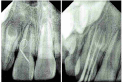 牙髓血管再生<font color="red">术</font>成功治疗牙中牙慢性根尖周炎1例报道