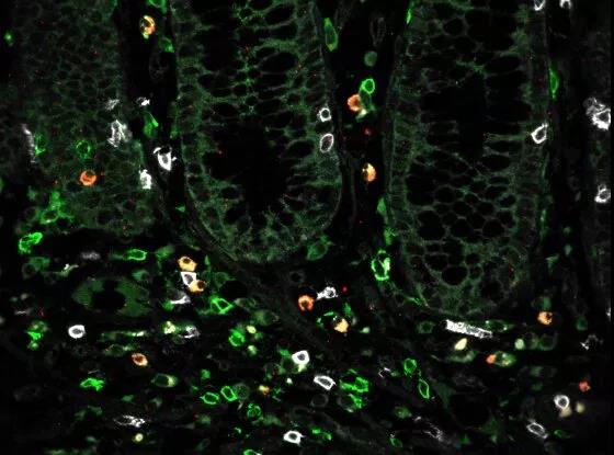 Cell：同病不同药？单细胞图谱揭示溃疡性结肠炎的耐药机制