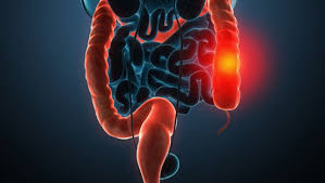 JCC： 早发性或长期炎症性肠病患者肠粘膜γδT细胞的表征及其与临床表现关系