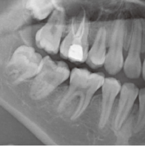 下颌第二磨牙C形根管根尖孔移位1例
