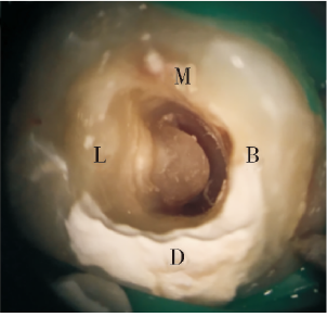 下颌第二磨牙c形根管根尖孔移位1例
