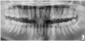 左下颌离体第二前磨牙畸形牙根1例