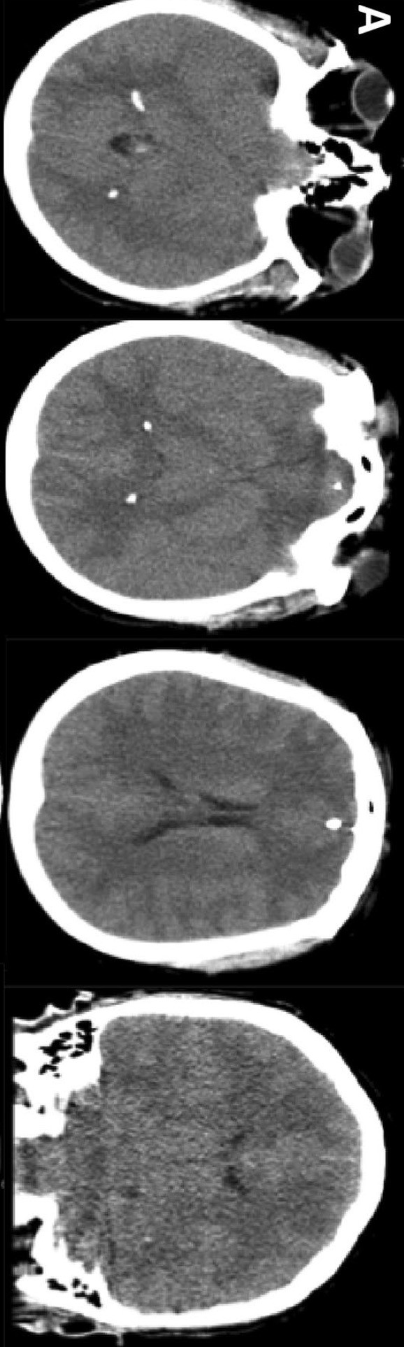 Neurocrit Care:渗透性药物纠正高颅压和脑水肿1例