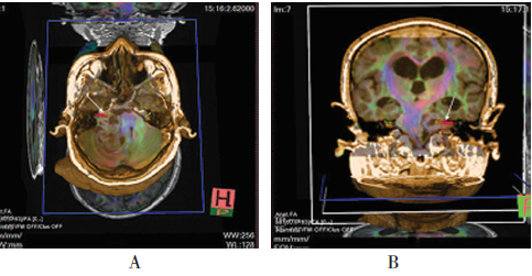 磁共振弥散<font color="red">张量</font>纤维束成像技术在听神经瘤中的应用