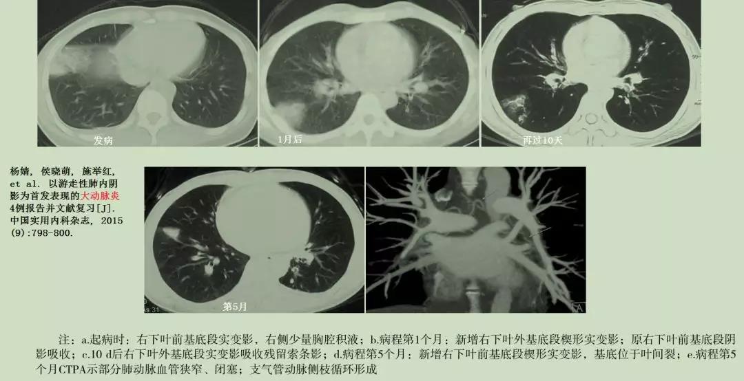 肺部游走性阴影，要考虑哪些疾病？