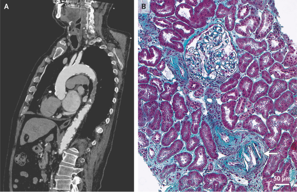 NEJM：经导管主动脉瓣膜置换术后胆固醇结晶栓塞-病例报道