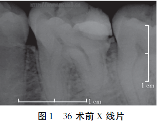 下颌第一磨牙近中3根管远中2根管1例