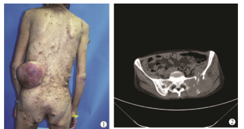 I 型神经纤维瘤病恶变伴骨破坏1 例