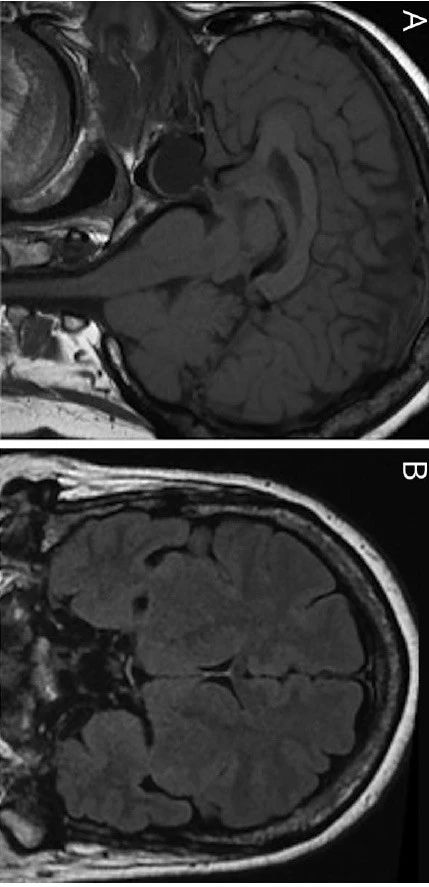 Neurology：乳突骨瘤与高颅压1例