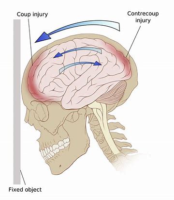 创伤性脑损伤：NYX-458显著改善认知表现和生物标志物