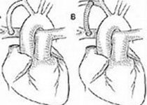 Heart：心房颤动不是主动脉瓣<font color="red">狭窄</font>患者预后的预测因素