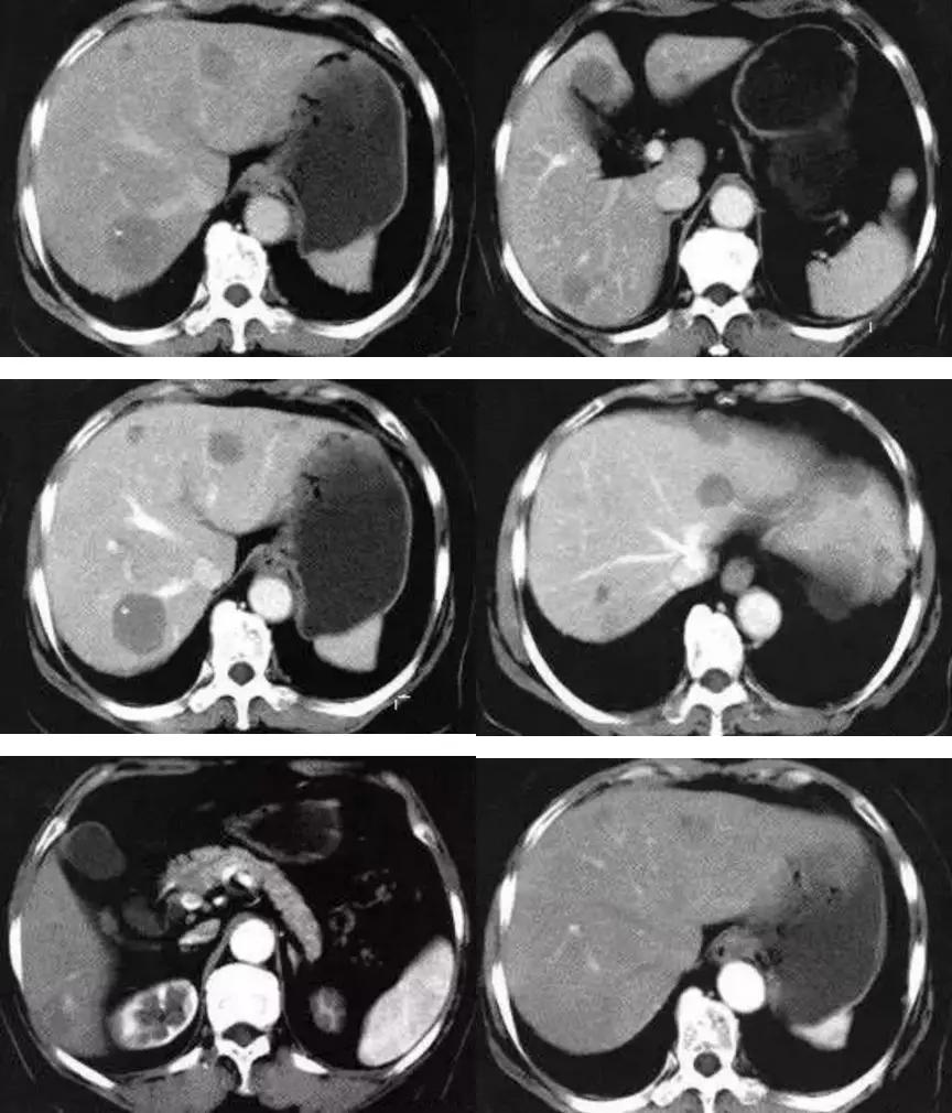 反复腹痛恶心，增强CT看见肝内有结节，是什么？