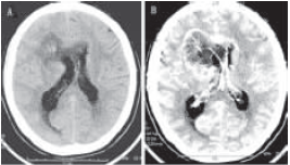 立体定向活检诊断结合32P内放射治疗大脑胶质瘤病1例
