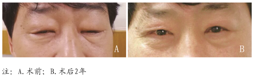 <font color="red">眼睑</font>木村病临床特点与手术方法探讨