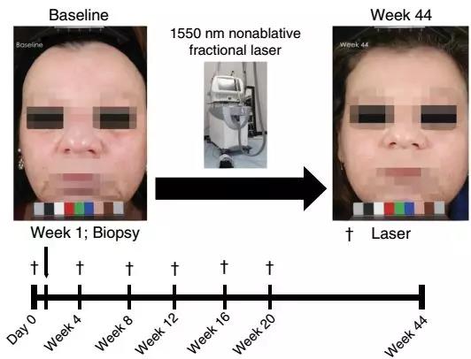 Nat Commun：破解激光祛疤祛皱之谜！霍普金斯大学科学家发现，激光能激活一条重要毛囊再生通路，促进皮肤重获新生