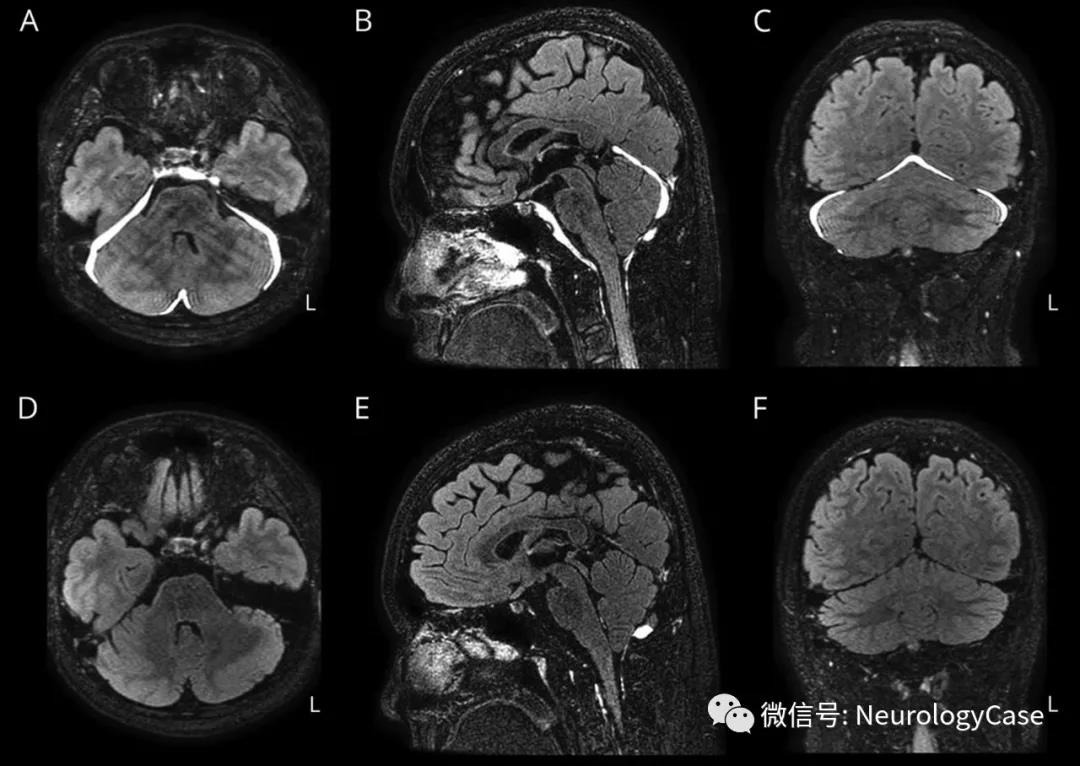 Neurology 见于mog抗体相关疾病的硬脑膜肥大病例 Medsci Cn