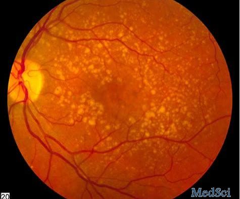 2019年美国眼科学会：基因疗法ADVM-022治疗湿性AMD的24周数据