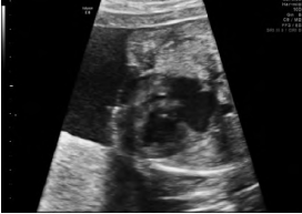 超声诊断胎儿完全型Cantrell五联征1例