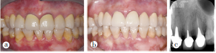 口腔扁平苔藓患者前牙区运用牙冠延长术及冠修复恢复功能和改善美观（附1例报告）