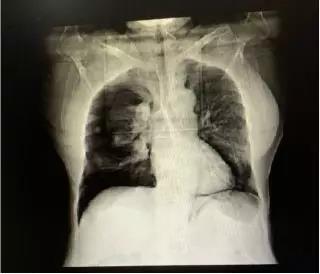 肺组织压缩50-55%！极易危及生命！这种情况护士要会识别