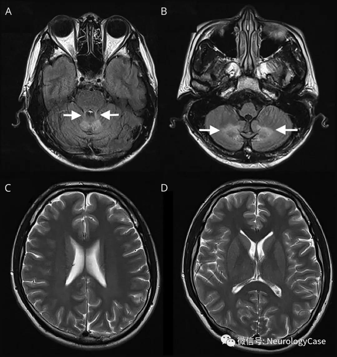 Neurology病例：X连锁肾上腺脑白质营养不良：脊髓小脑变<font color="red">异型</font>