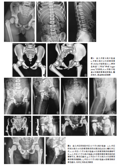 骨硬化症并股骨颈骨折1例