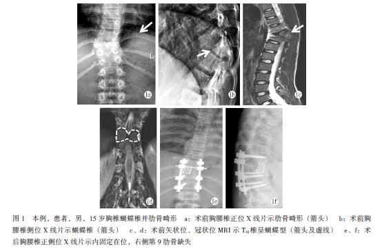 手术治疗儿童胸椎蝴蝶椎并肋骨畸形1例