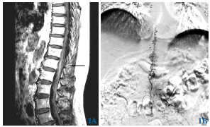 硬脊膜动静脉瘘误诊急性脊髓炎1例