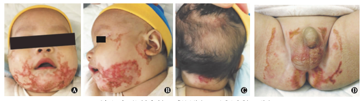 婴儿肠病性肢端皮炎 1 例