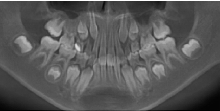 右侧上颌第一磨牙迟萌伴同颌数颗恒牙先天缺失1例