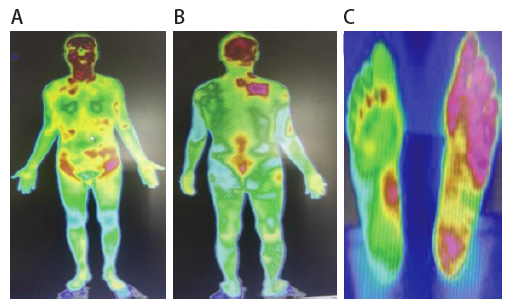 红外热成像图发现骶神经鞘瘤1例