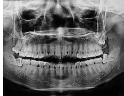 下颌第三磨牙阻生及其拔除导致邻牙牙周炎形成的原因分析和治疗（附1例报告）