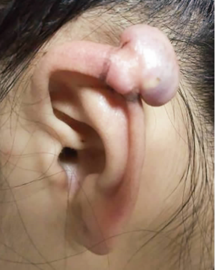 手术切除与术后压力治疗耳郭瘢痕疙瘩 1 例