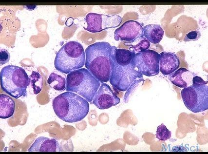 2019年S​​OHO：Venetoclax联合Navitoclax治疗复发难治ALL和淋巴母细胞淋巴瘤前景光明