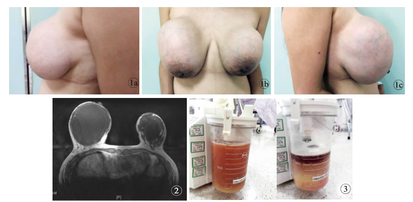聚丙烯酰胺水凝胶隆乳术后 16 年 乳房罕见畸形一例报告