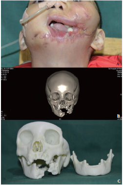 腓骨肌皮瓣修复6岁儿童创伤性口腔颌面部缺损：1例报告及文献复习