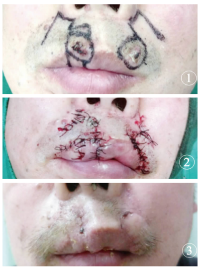 多种皮瓣联合应用修复上唇部多发性基底细胞癌一例