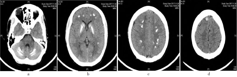 脑内多发钙化1例报告及鉴别诊断