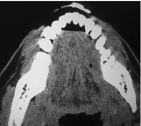 左下颌牙龈成釉细胞纤维瘤1例报告