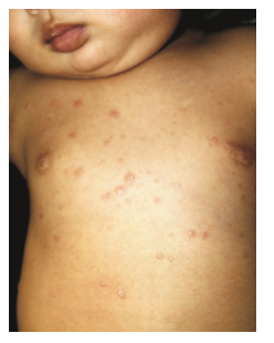 儿童感染hpv丘疹图片图片