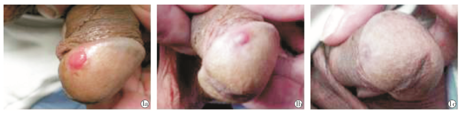 误诊为生殖器疱疹的浆细胞性龟头炎1 例